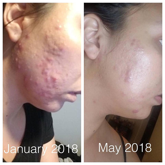 Super Acne Fighter Treatment - Kadaluu